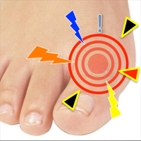 Gout Diagnosis