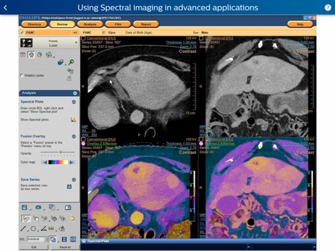 Philips IQon Spectral CT Fundamentals screenshot 4