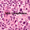 Skin Lymphoma Treatment-The Illustrated Guide