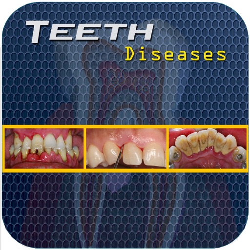 Teeth Diseases v1