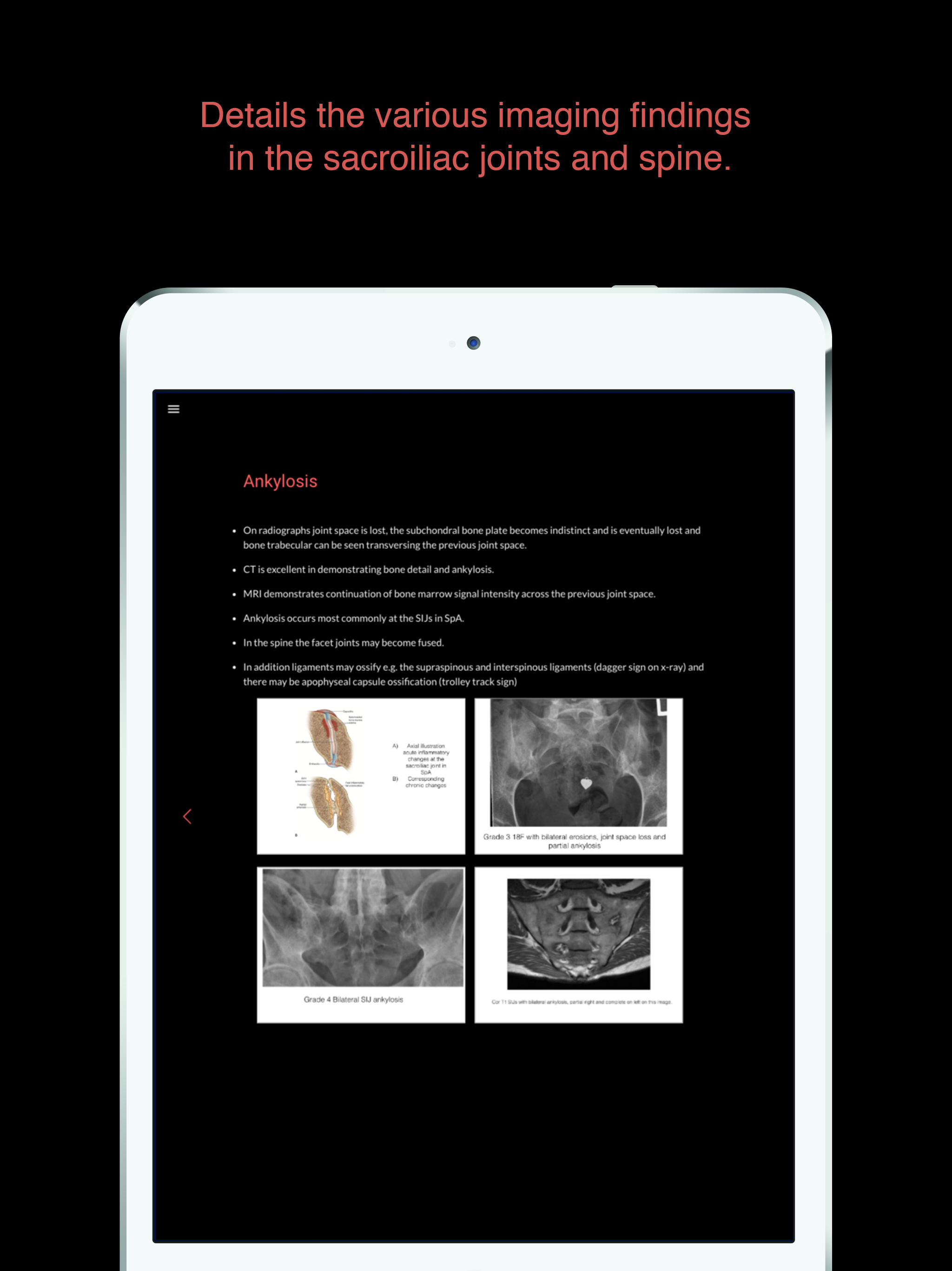ESIMR: UnRavelling Spondyloarthropathy
