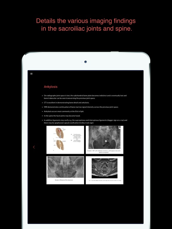 Screenshot #5 pour ESIMR: UnRavelling Spondyloarthropathy