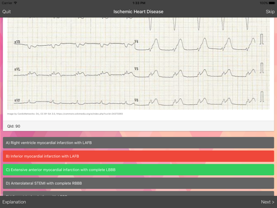 ECG Master - Quiz, Exam, Explanation, Statistic iPad screenshot 4 - Medical app