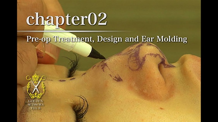 Nasal tip refinement - conchal cartilage grafts