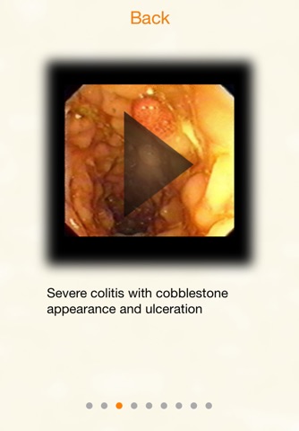 AnswersIn Ulcerative Colitis screenshot 4