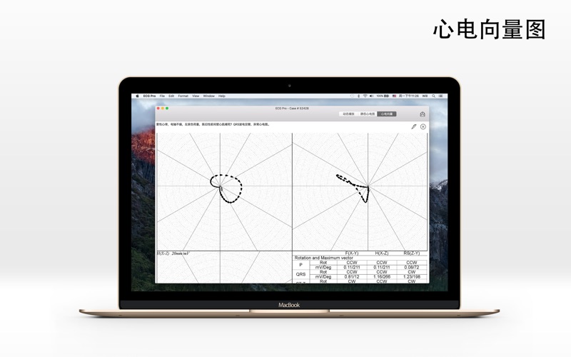 ECG Pro - 12导联静态和动态心电图案例