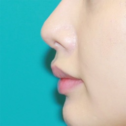 Nasal tip refinement - conchal cartilage grafts