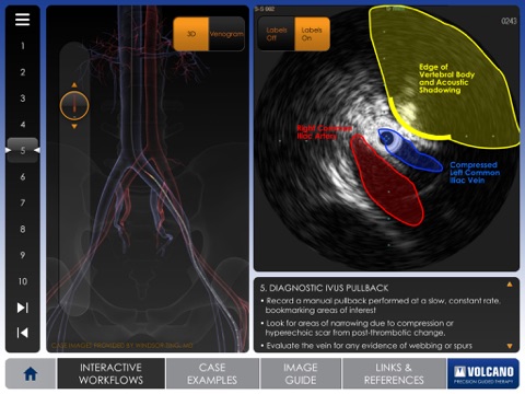 Philips Venous IVUS Tutor screenshot 3