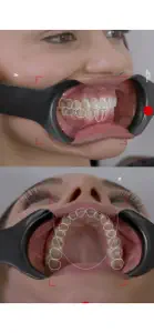 Dental Shooting v2 screenshot #4 for iPhone