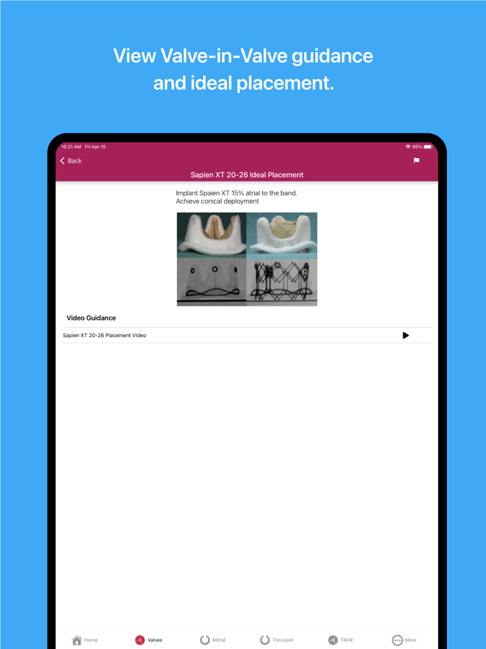 Valve In Valve Mitral