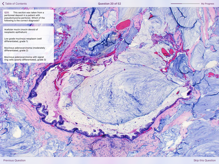 Appendiceal Pathology