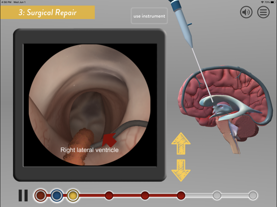 Screenshot #6 pour Hydrocephalus Procedure