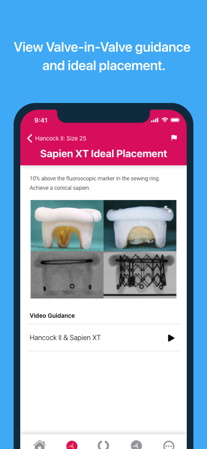 Valve In Valve Mitral