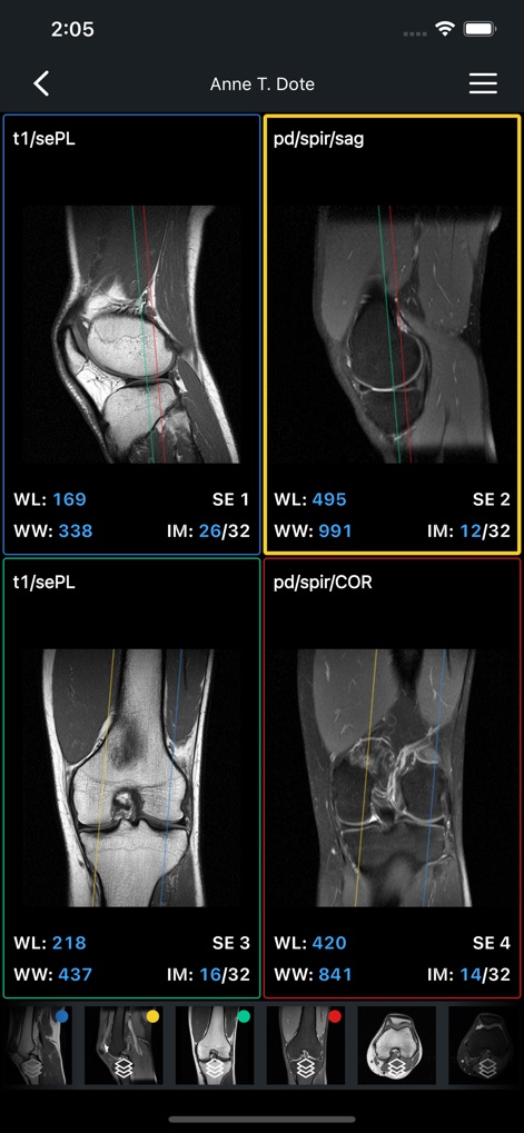 IDV - IMAIOS DICOM Viewer - L'application affiche des coupes simultanées avec des paramètres d'affichage distincts (comme WL et WW) et des lignes de référence croisées pour une analyse anatomique précise.