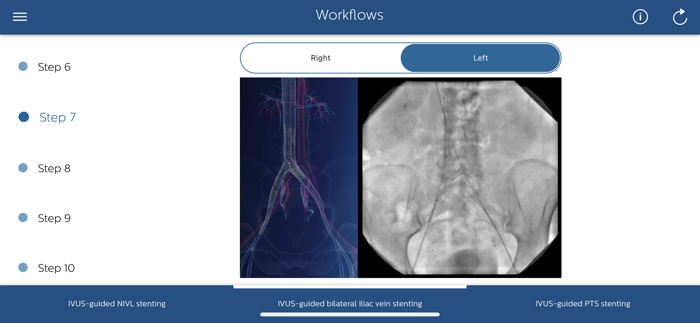 Philips Venous IVUS Tutor
