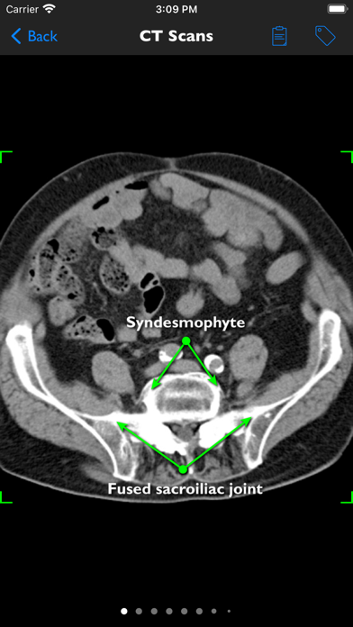 iAnkylosingSpondylitis Pro Screenshot