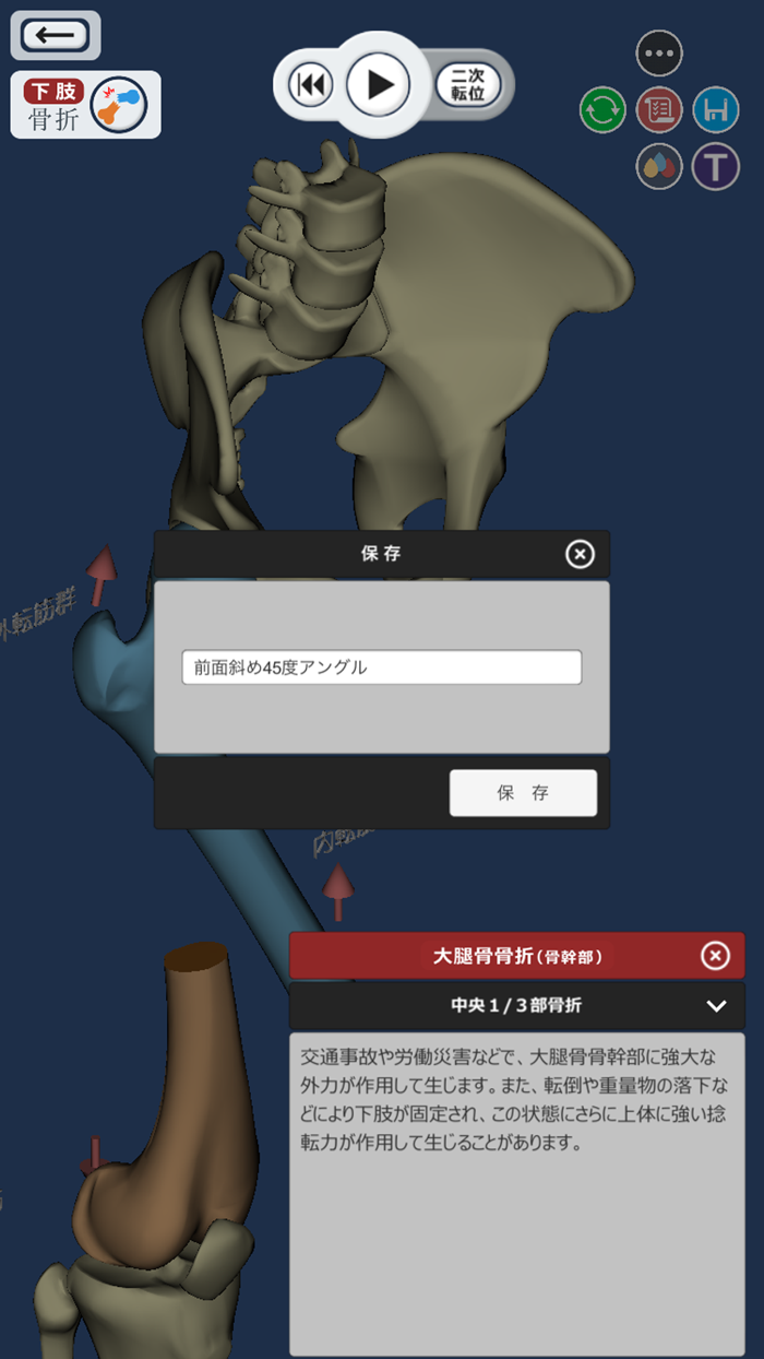 ３Dで分かる骨折と脱臼