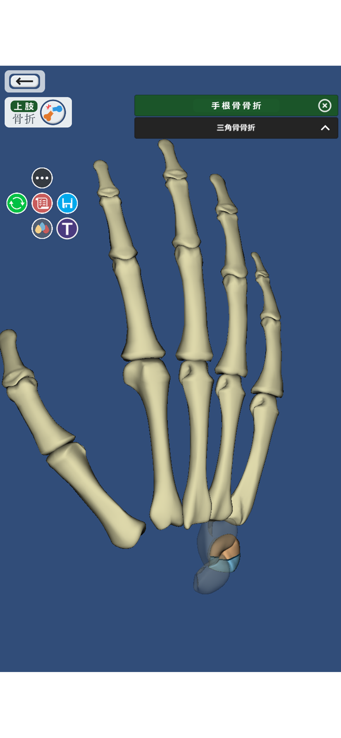３Dで分かる骨折と脱臼