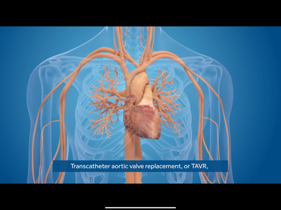 AS TAVR Education iPad screenshot 4 - Medical app