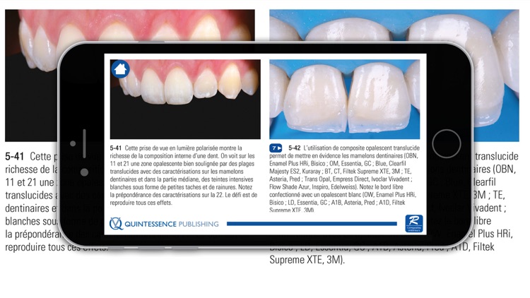 Composites antérieurs