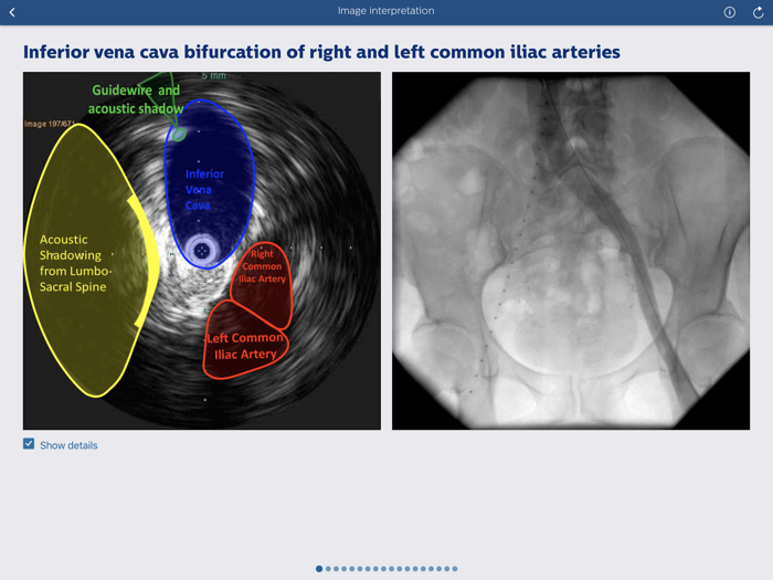 Philips Venous IVUS Tutor