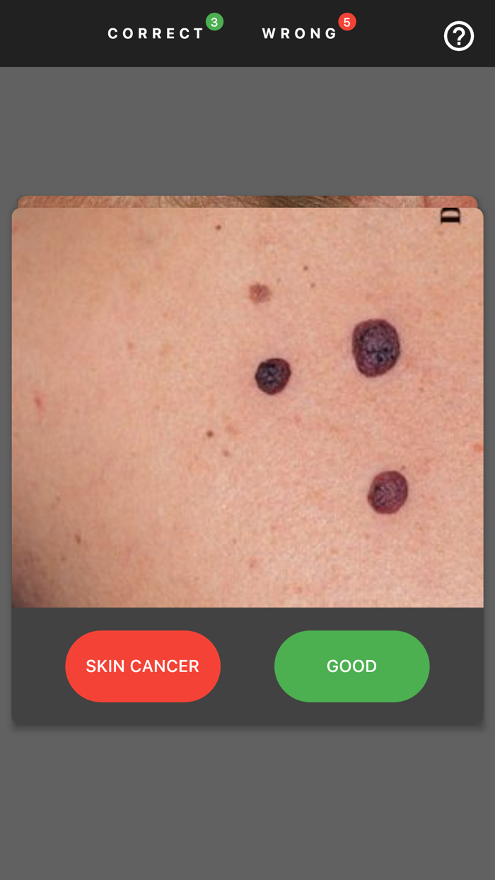 MelanomaExam