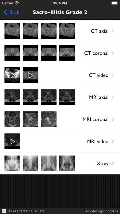 Screenshot #3 pour iAnkylosingSpondylitis Pro