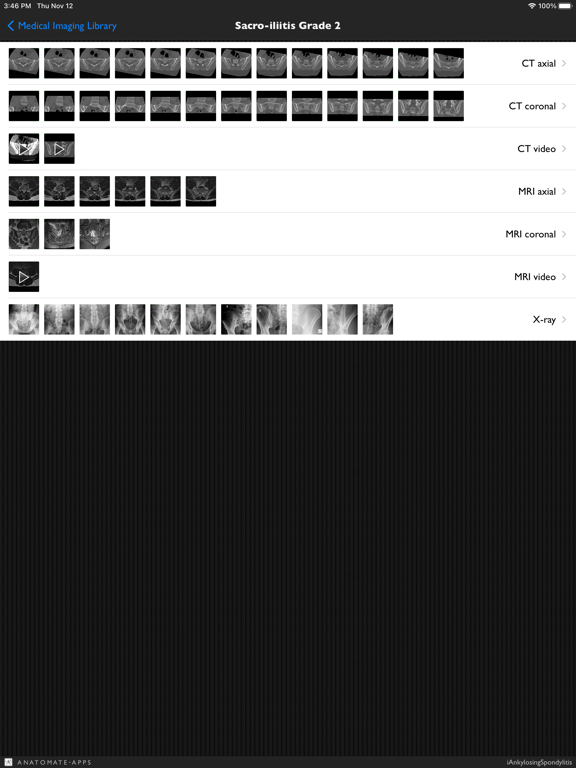 Screenshot #6 pour iAnkylosingSpondylitis Pro