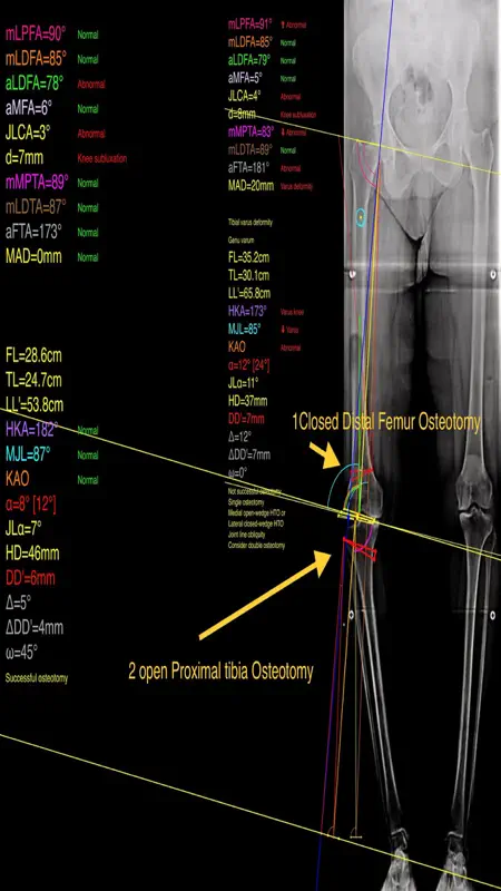 OsteotomyApp screenshot 5 of 6