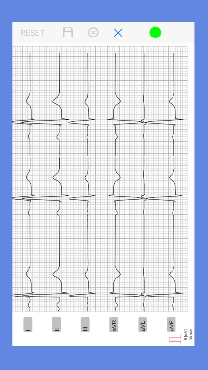 AIS ECG App