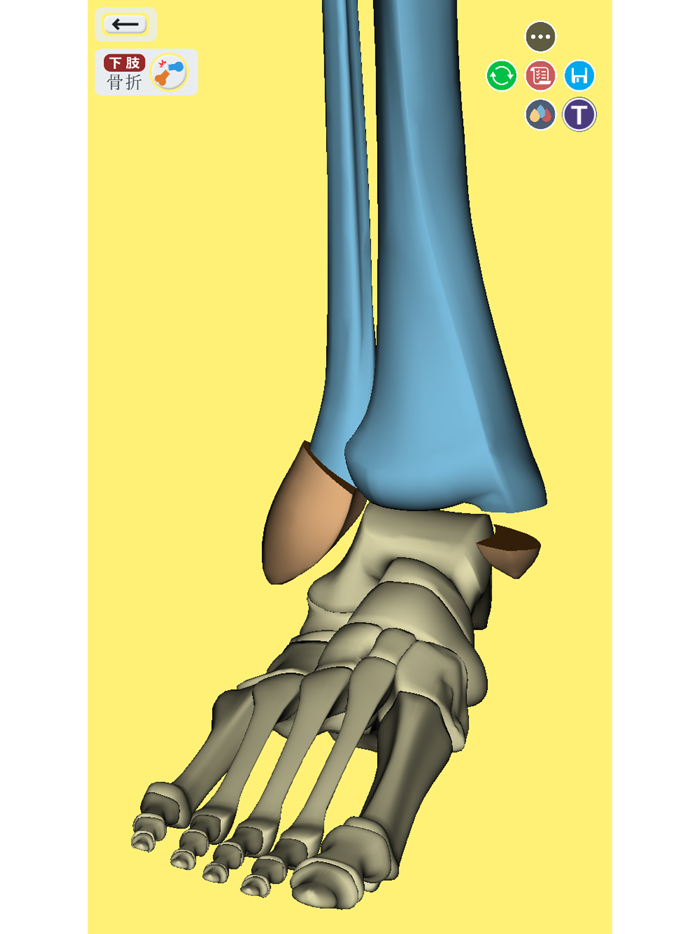 ３Dで分かる骨折と脱臼