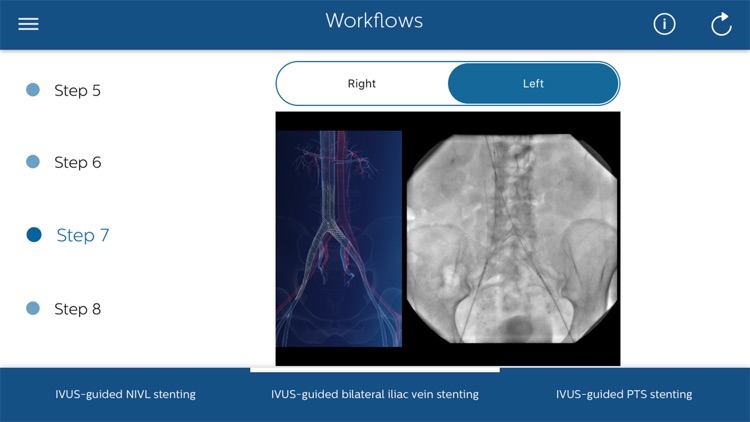 Philips Venous IVUS Tutor screenshot-6