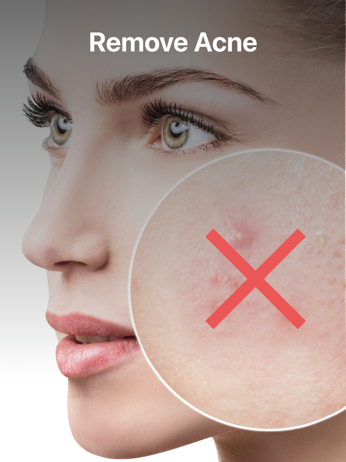 Blemish Acne Pimple remover