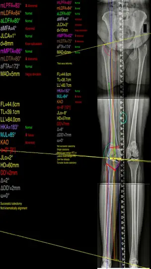 Screenshot von OsteotomyApp auf dem iPhone 2