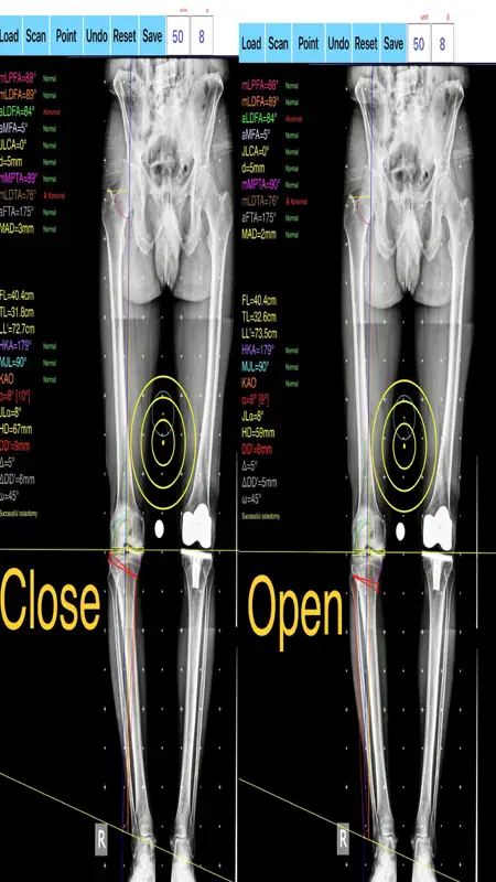 OsteotomyApp screenshot 6 of 6