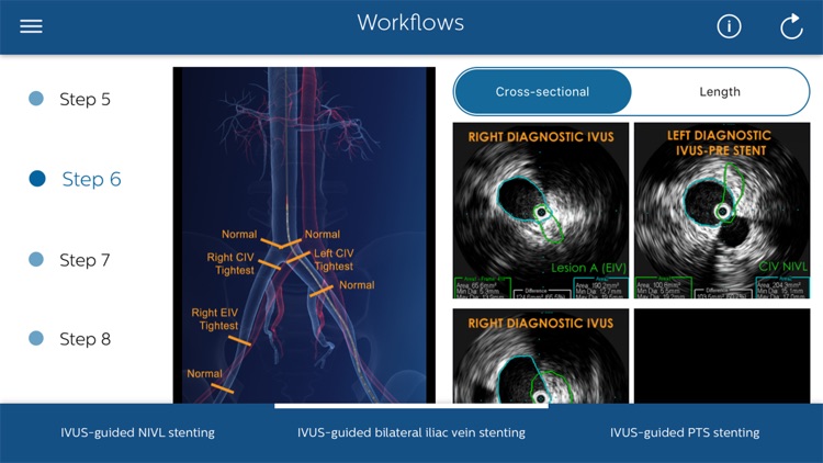 Philips Venous IVUS Tutor screenshot-5