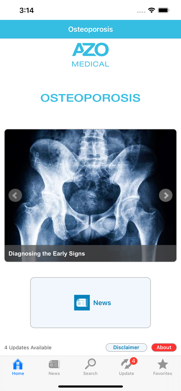 Osteoporosis by AZoMedical