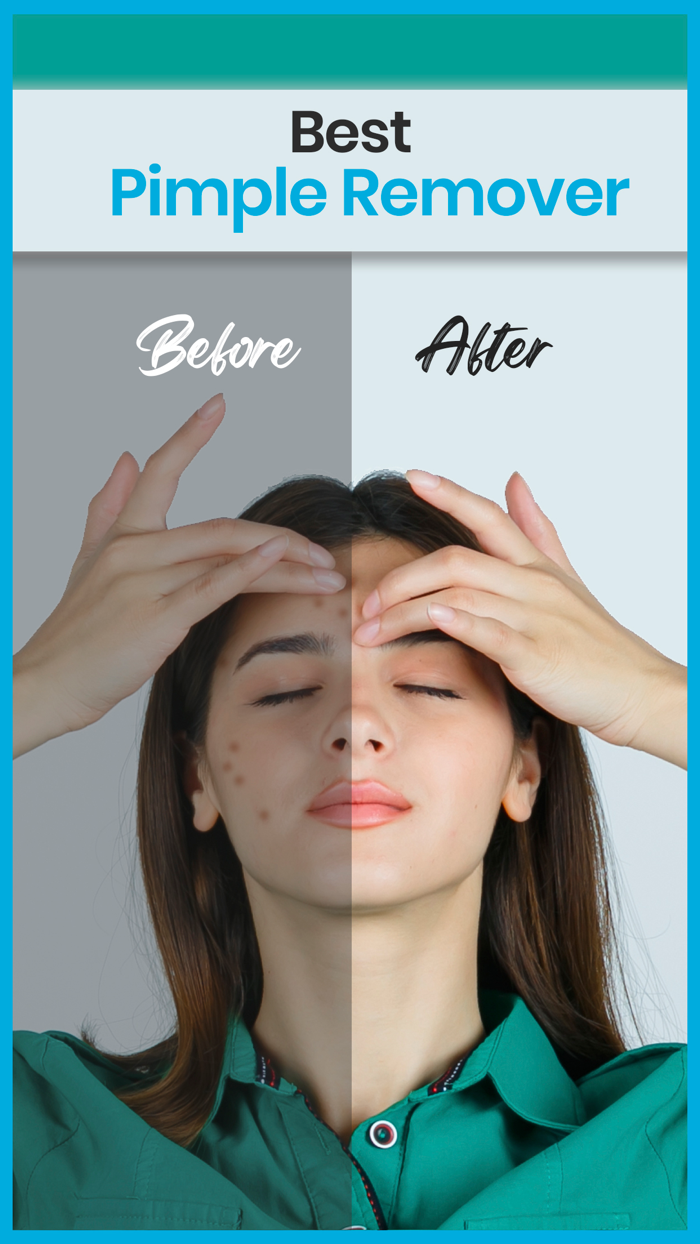 Pimple Remover 