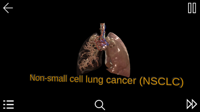 Non-Small-Cell Lung Cancer Screenshot