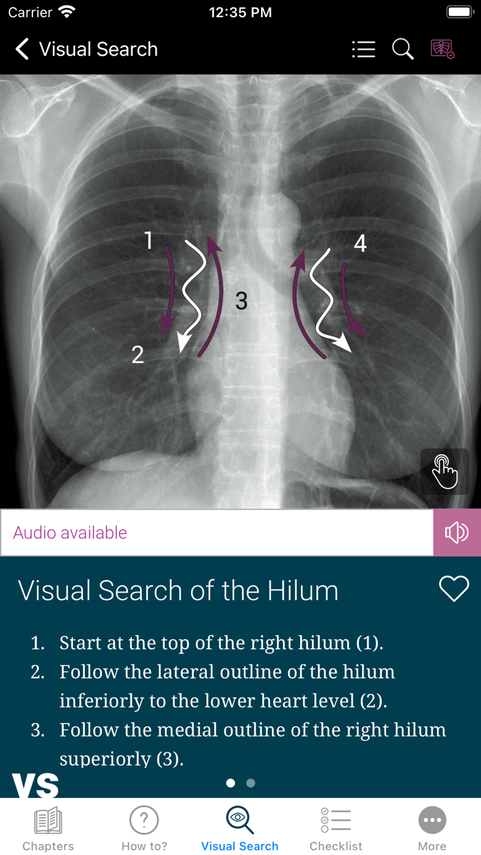 Chest X-ray Interpretation