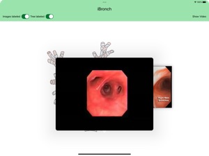 iBronch screenshot #3 for iPad