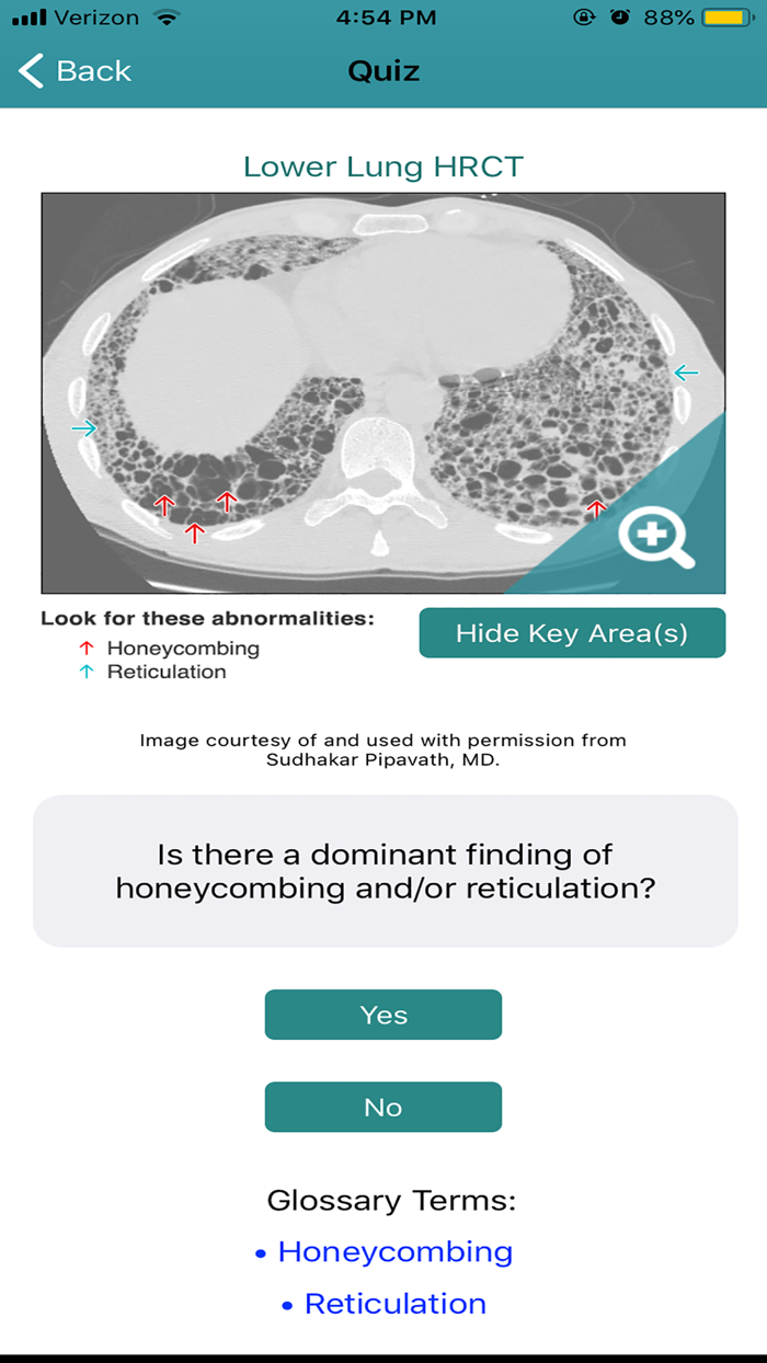 Rad Rounds UIP to IPF