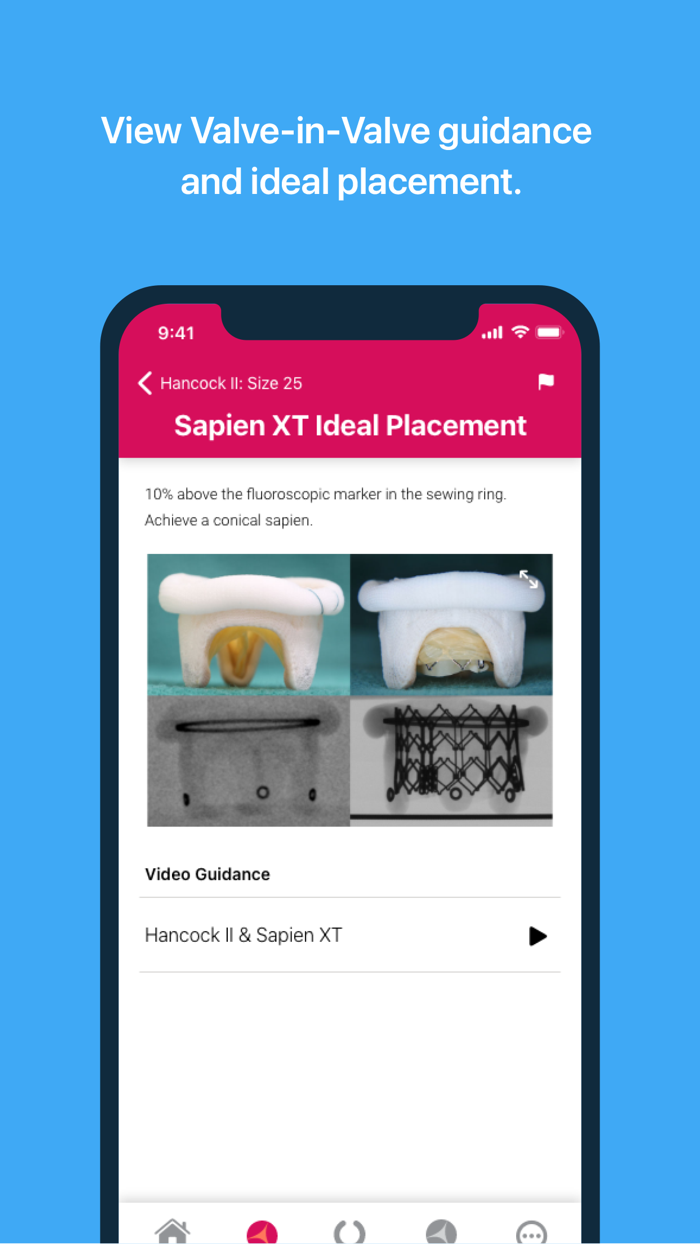 Valve In Valve Mitral