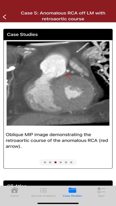 CTisus CT Coronary Arteries Screenshot