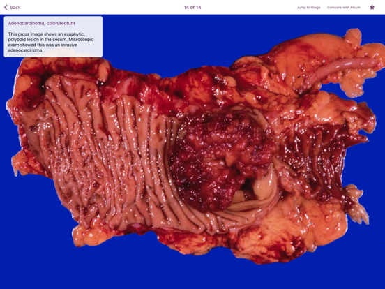 Screenshot #6 pour Colonic Pathology