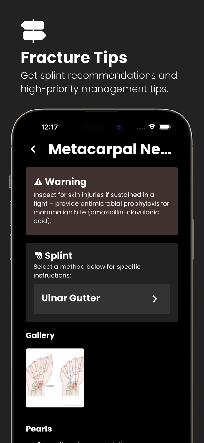 Fractures Splinting App