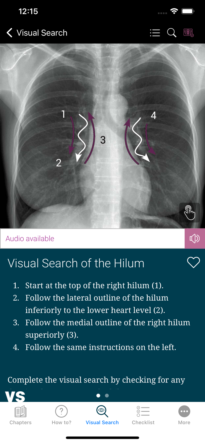 Chest X-ray Interpretation