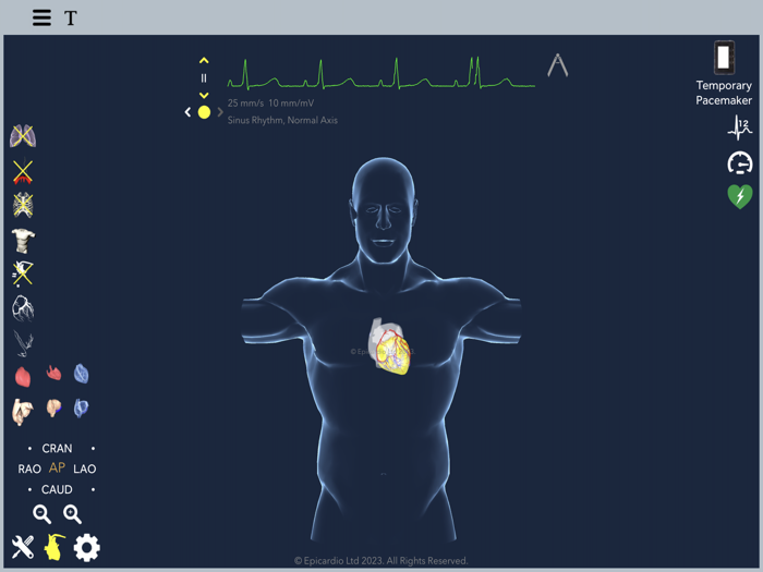 Temporary Cardiac Pacing