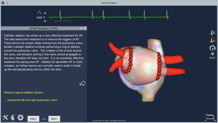 Atrial Fibrillation