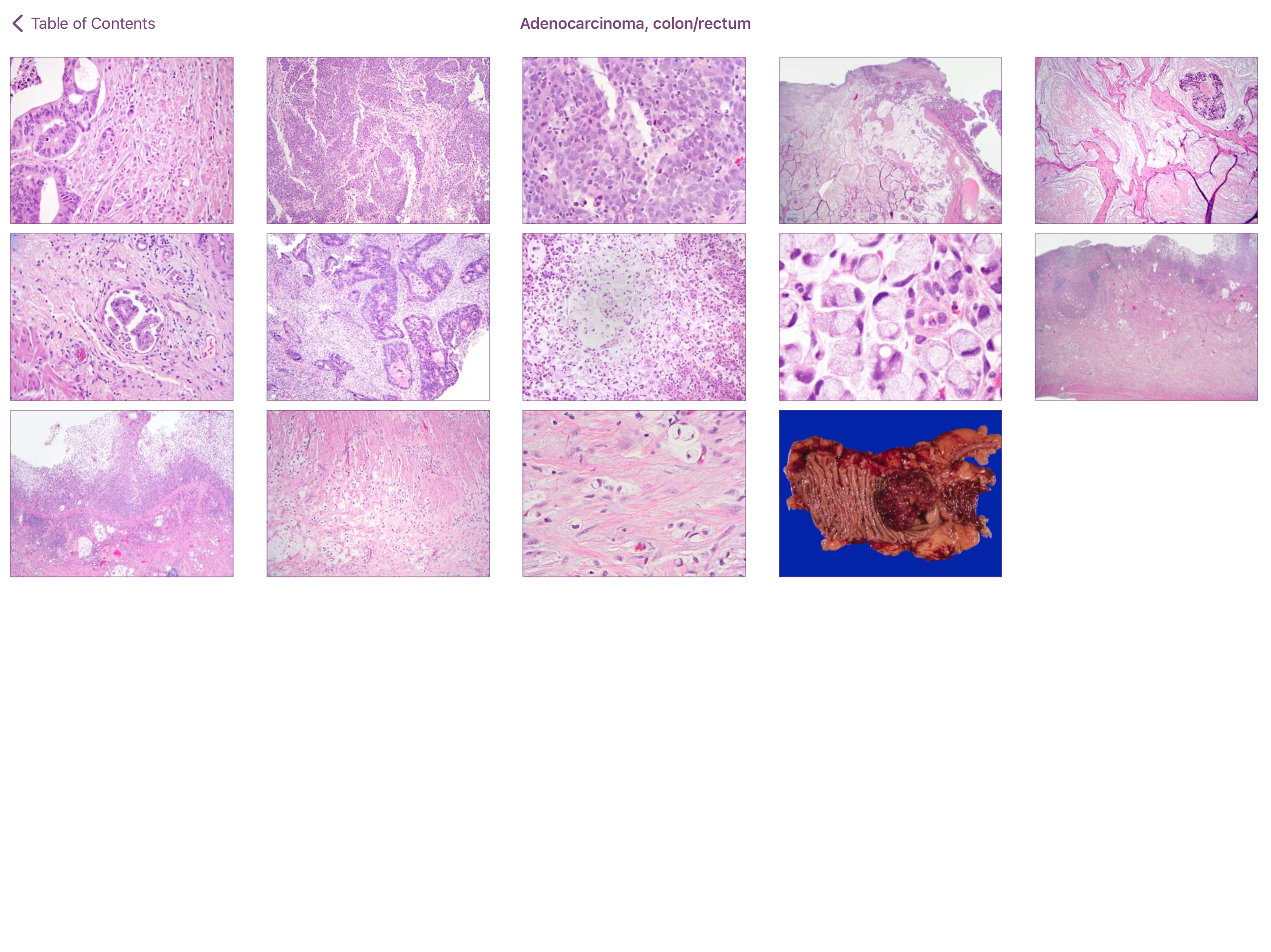 Colonic Pathology